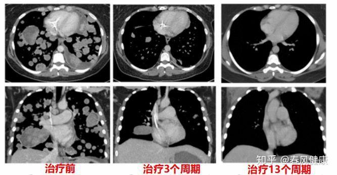 癌癥治療新突破，重塑生命之光之旅