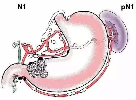 最新腫瘤TNM分期標(biāo)準(zhǔn)詳解